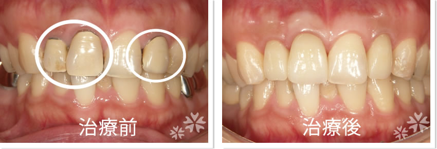 クラウン実績1　治療前　治療後
