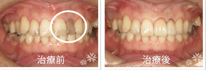 クラウン実績2　治療前　治療後
