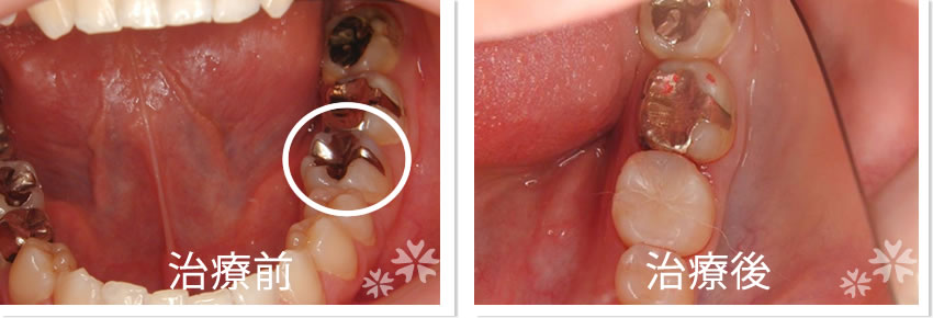 インレー実績1　治療前　治療後