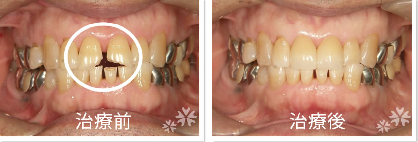 ラミネートべニア実績　治療前　治療後