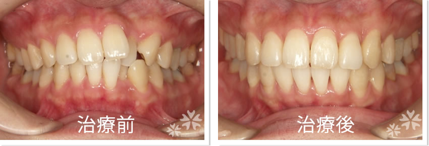 矯正症例1　治療前　治療後