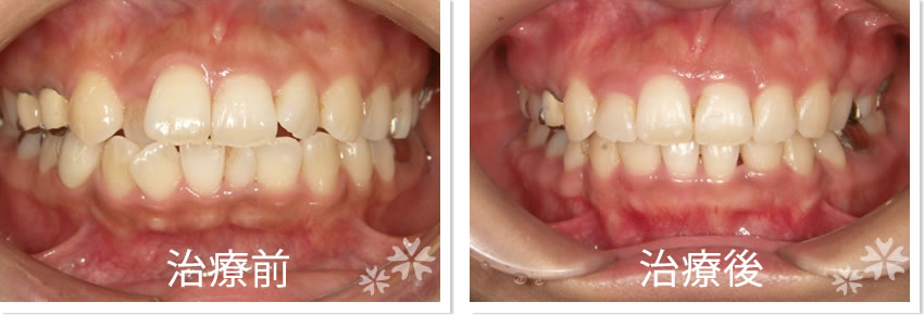 矯正症例　治療前　治療後