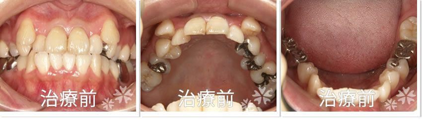 矯正症例3　治療前