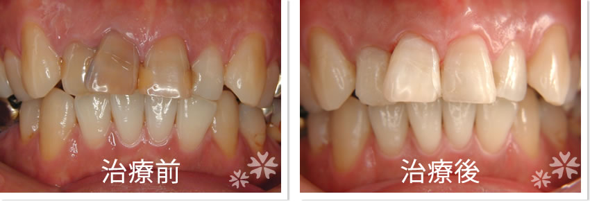 ウォーキングブリーチ治療前　治療後