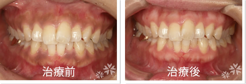 歯ぐきのメラニン除去　治療前　治療後